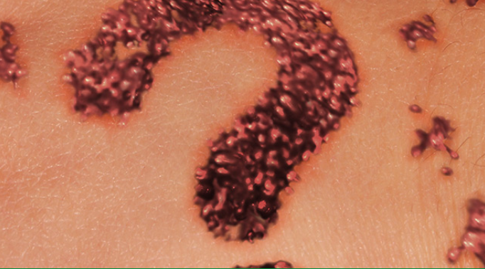 Oz Skin Cancer Clinic Pakenham - Skin Cancer Checks Bulk Billed